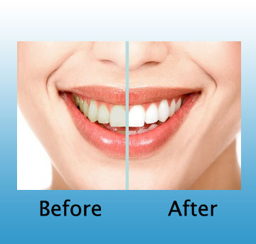Check out the laser tooth whitening photo before and after, and you 