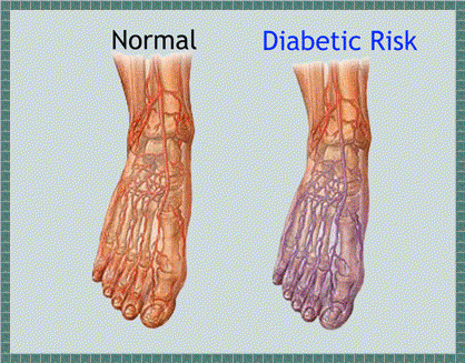 Diabetic Foot Pain Symptoms, Remedies, Treatment