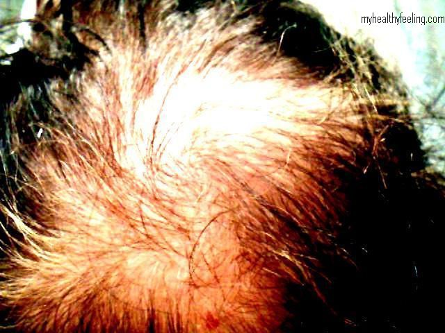 What causes itching scalp and hair loss?