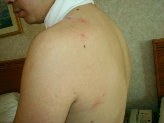 Bed bug bites symptoms Bed Bug Treatment Site