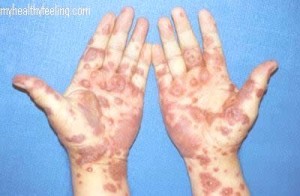 Poison ivy treatment topical steroids