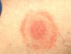 What is the treatment for tick bites?