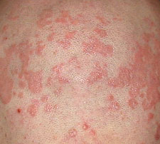 dry skin rashes