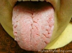 Geographic Tongue: Causes and Treatments - WebMD