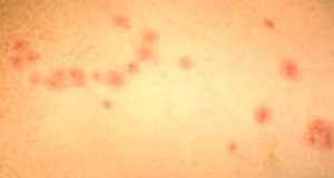 Insect Bite Identification â€“ Blister, Infection, Reaction, Pictures