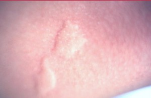 Insect Bites and Stings | Bug Bites | MedlinePlus