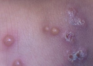 Bug Bites Pictures Slideshow: Identifying Bugs and ... - WebMD